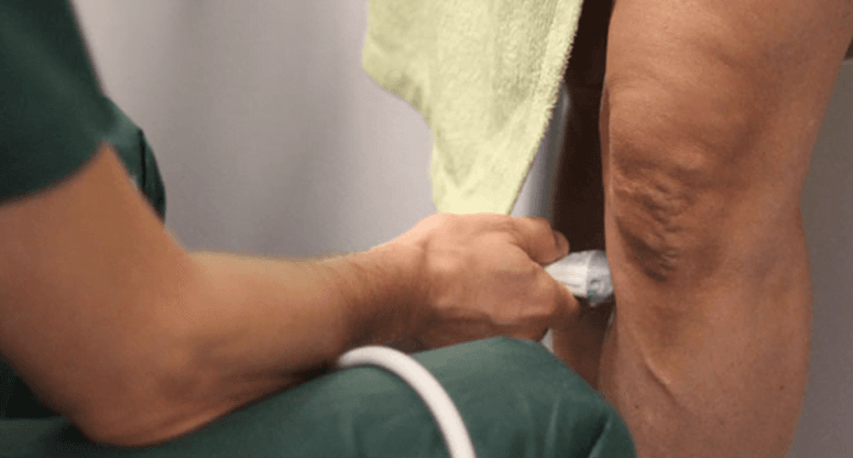 Synlige blodårer på bena