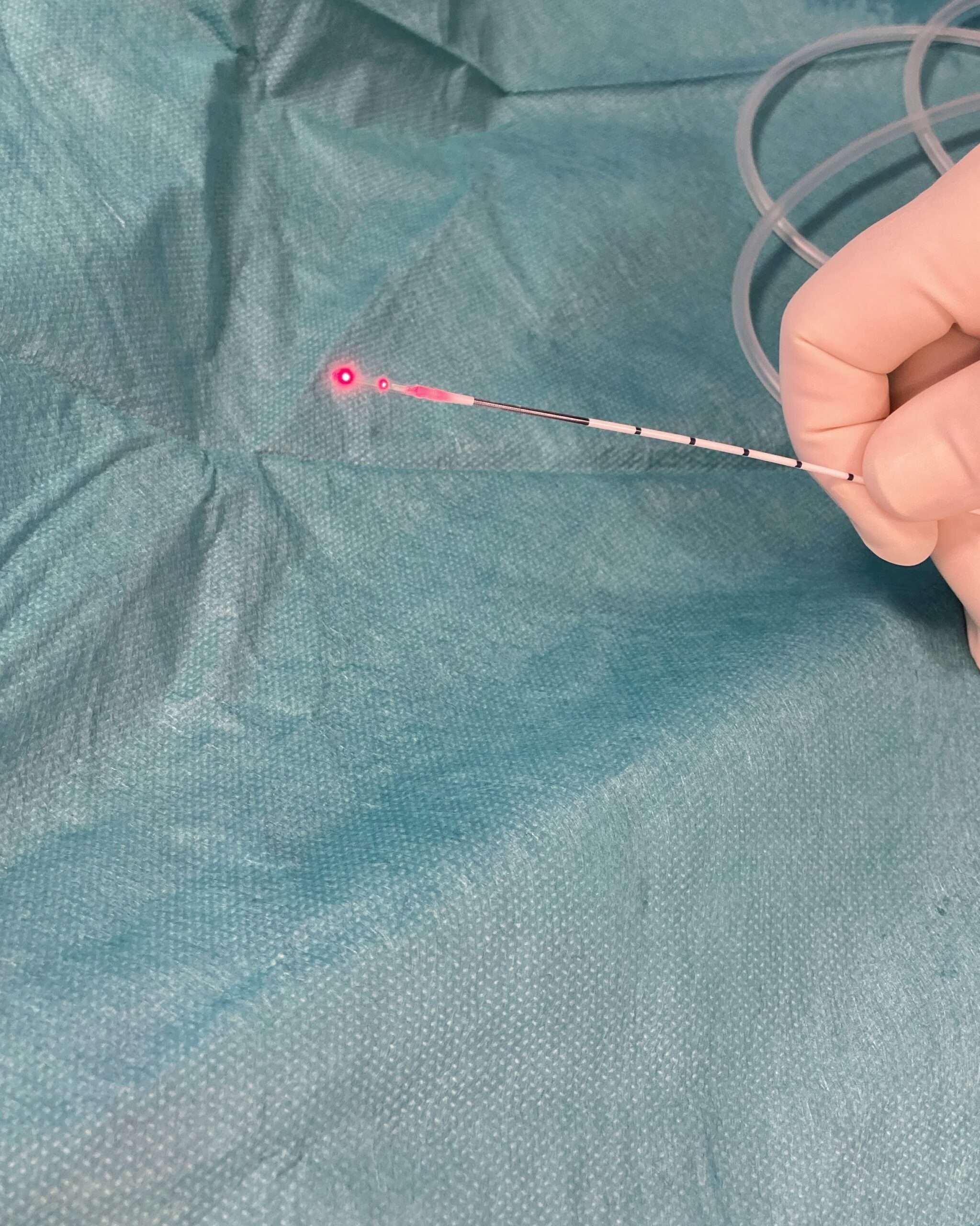 Laserfiber føres inn i åreknute under behandling