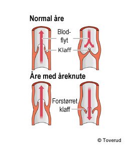 Illustrasjon av åreknute sammenlignet med normal vene