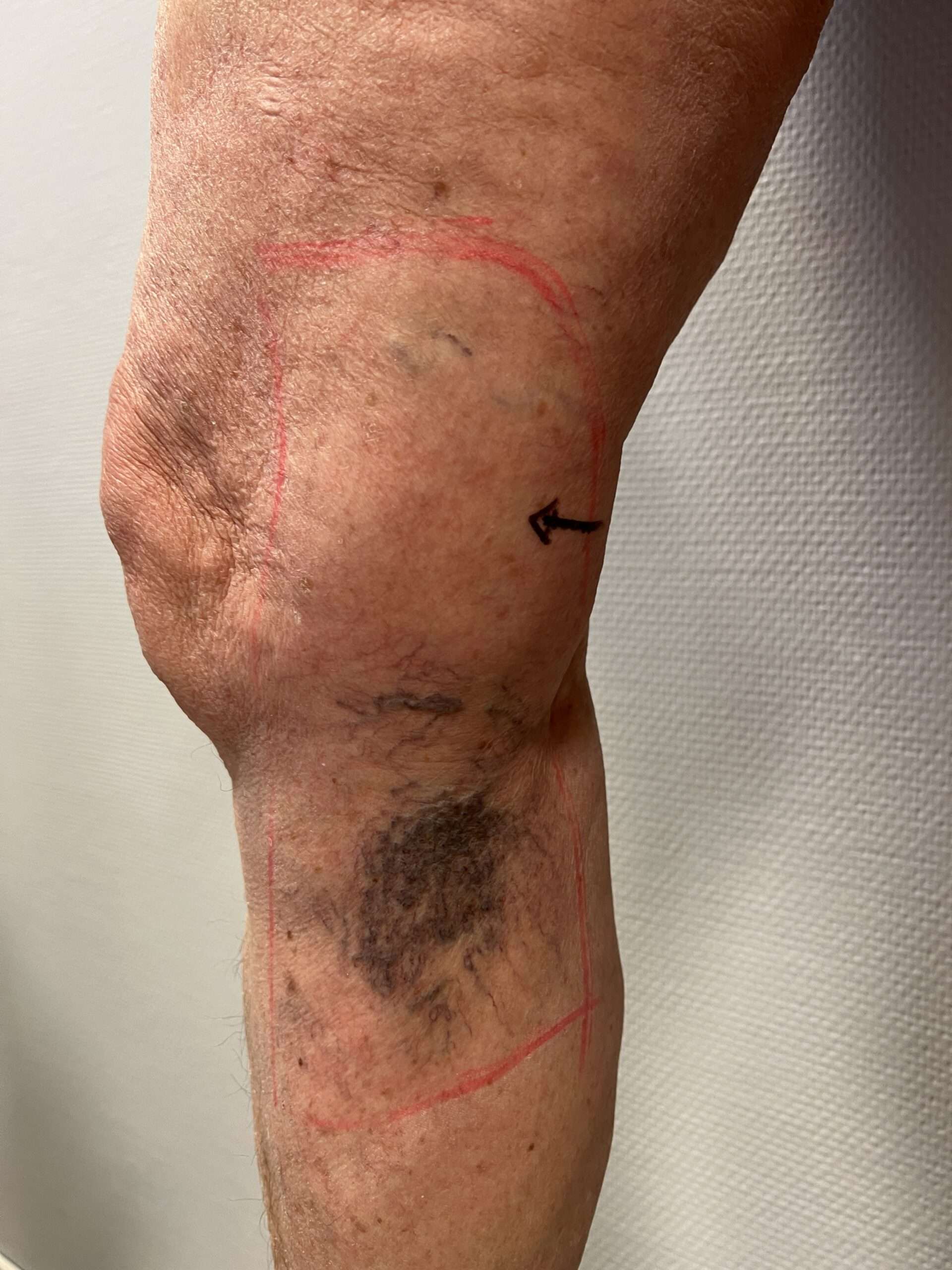 Sprengte blodkar markert for behandling